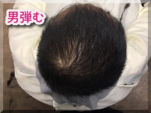 育毛の成功画像・頭頂部の薄毛対策