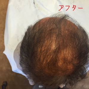 育毛のランキング・５０代の頭皮ケアでの育毛